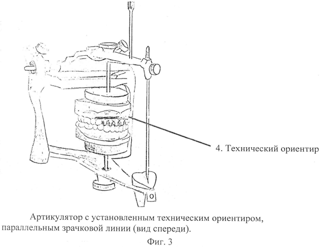 Способ конструирования протетической плоскости (патент 2573555)