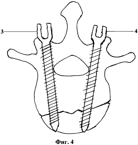 Способ репозиции и фиксации позвоночника при оскольчатых переломах (патент 2436534)