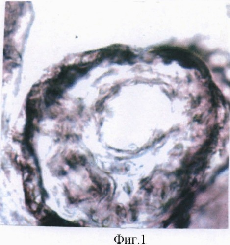 Способ выявления влияния герпес-вирусной инфекции на активность сквалендегидрогеназы на гистологических срезах плаценты при введении в инкубационный раствор содержимого герпесных пузырьков беременной (патент 2479843)