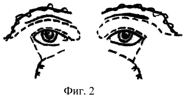 Способ закрытия билатерального тотального дефекта обоих век внутреннего и наружного углов глаза (патент 2446776)