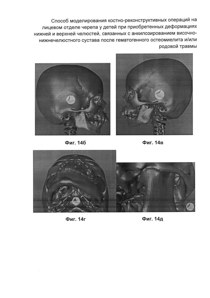 Способ моделирования костно-реконструктивных операций на лицевом отделе черепа у детей при приобретенных деформациях нижней и верхней челюстей, связанных с анкилозированием височно-нижнечелюстного сустава после гематогенного остеомиелита и/или родовой травмы (патент 2604774)