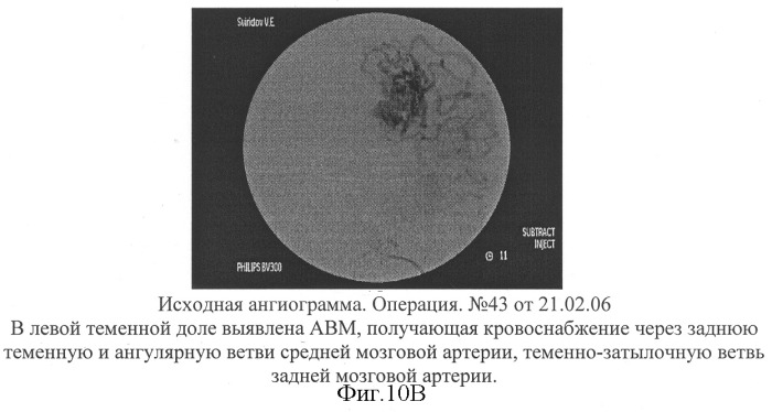 Способ эмболизации артериовенозных мальформаций головного мозга в условиях общей анестезии и управляемой гипотонии (патент 2315634)