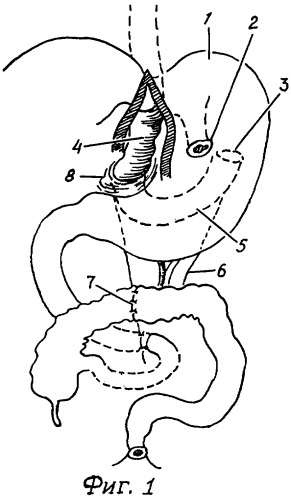 Способ наложения заднего толстокишечно-желудочного анастомоза при эзофагопластике (патент 2344769)