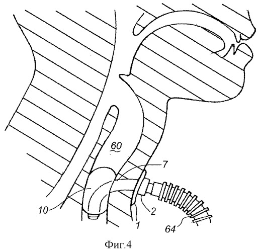 Аспирационная система, расположенная ниже голосовой щели (патент 2537944)
