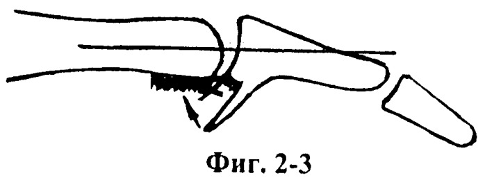 Способ лечения разгибательной контрактуры пальца в проксимальном межфаланговом суставе (патент 2464947)