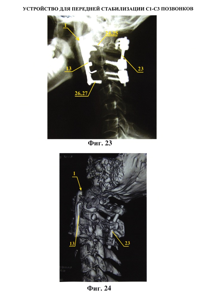 Устройство для передней стабилизации с1-с3 позвонков (патент 2615901)