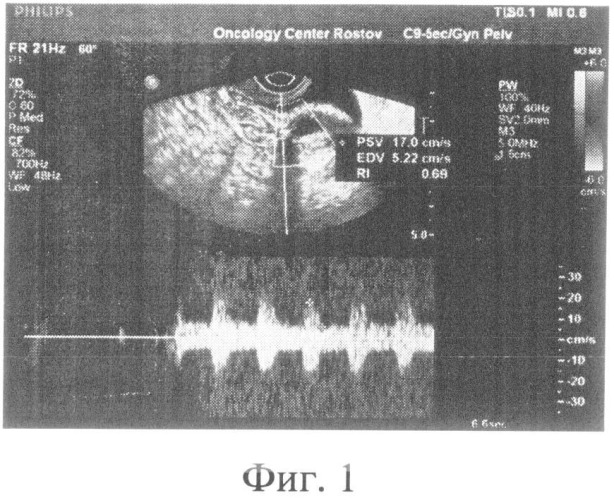 Способ ультразвуковой диагностики локальных рецидивов рака яичников (патент 2498773)