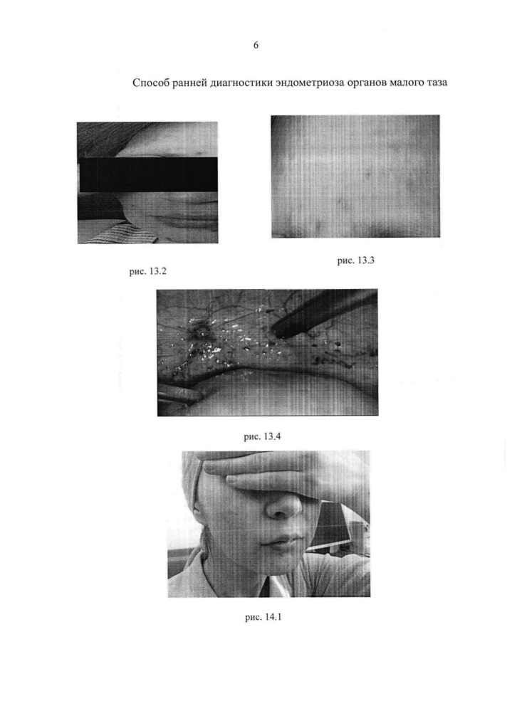 Способ ранней диагностики эндометриоза органов малого таза (патент 2616995)