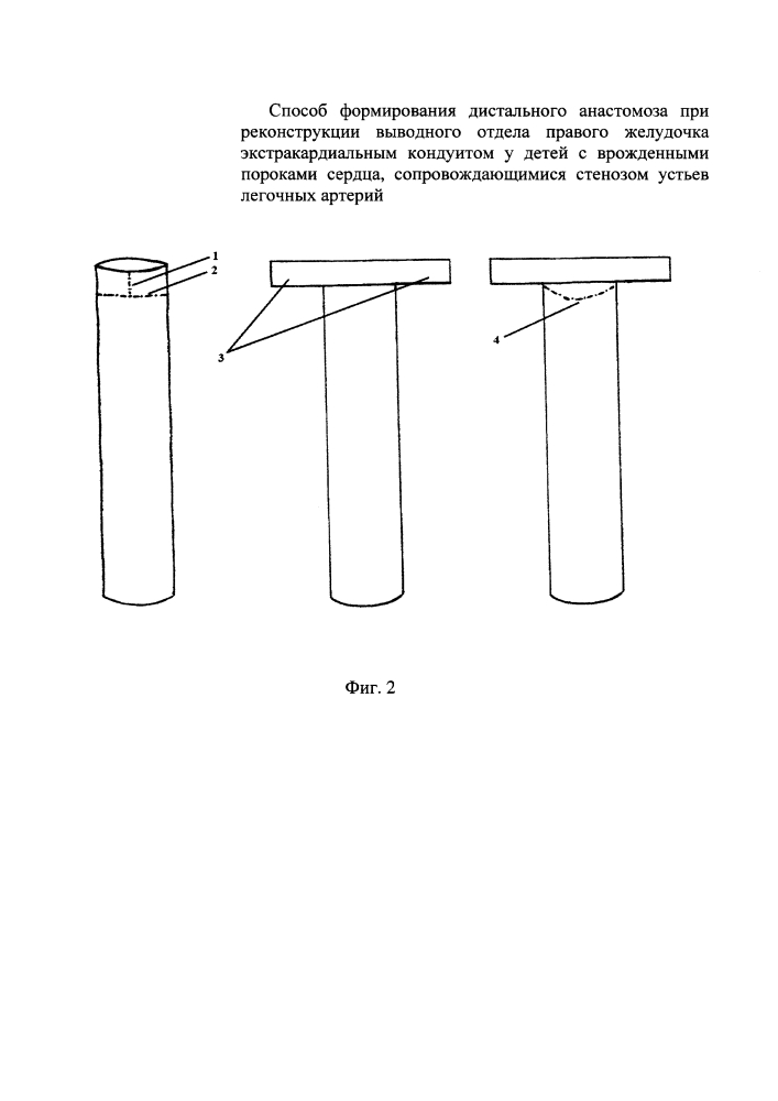 Способ формирования дистального анастомоза при реконструкции выводного отдела правого желудочка экстракардиальным кондуитом у детей с врожденными пороками сердца, сопровождающимися стенозом устьев легочных артерий (патент 2639030)