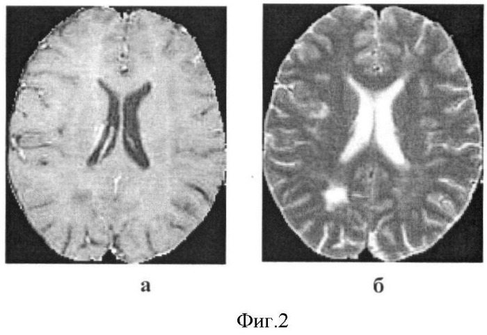 Способ определения тяжести дегенеративных изменений в головном мозге больных рассеянным склерозом (патент 2426495)