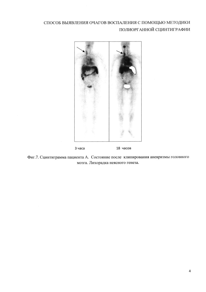 Способ выявления очагов воспаления с помощью методики полиорганной сцинтиграфии (патент 2648877)