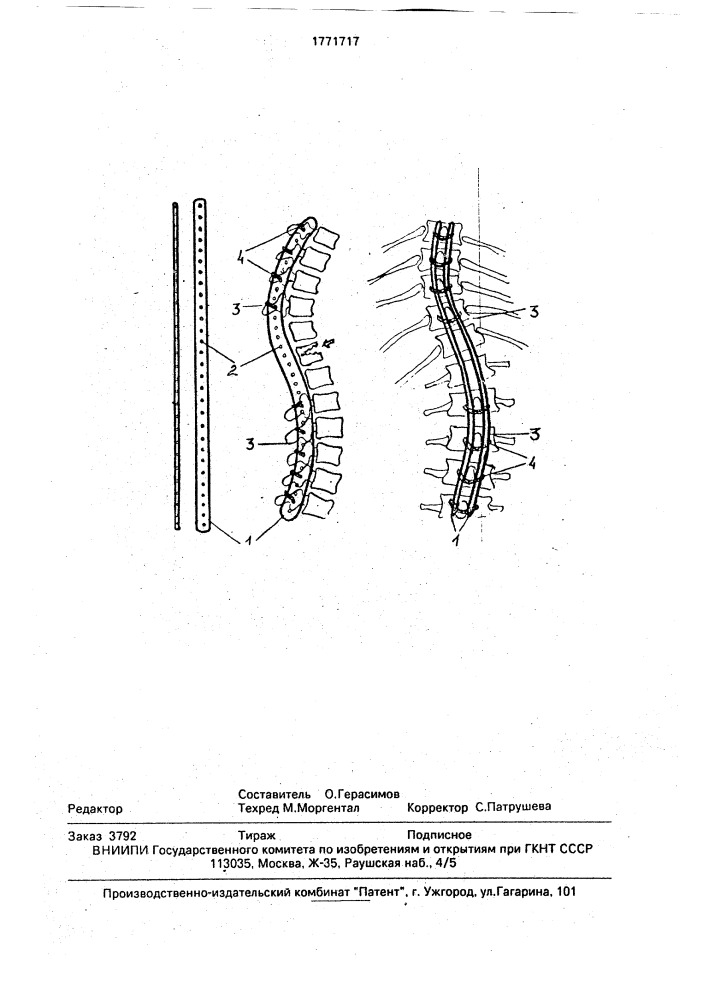Устройство для стабилизации позвоночника (патент 1771717)