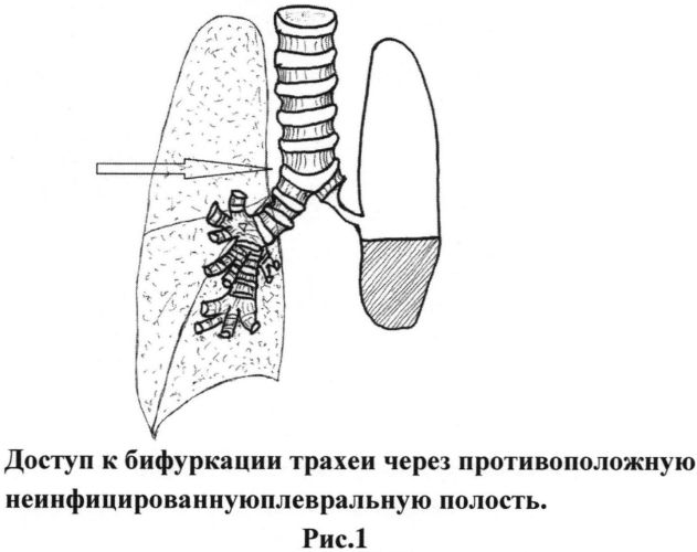 Способ хирургического лечения бронхоплеврального свища, возникшего после полного удаления легкого (патент 2558455)