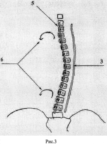 Способ коррекции идиопатического сколиоза позвоночника грудопоясничной локализации у детей (патент 2562511)