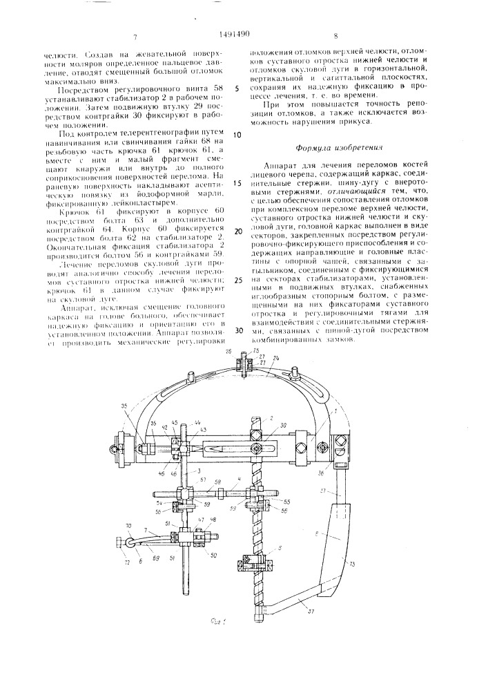 Аппарат для лечения переломов костей лицевого черепа (патент 1491490)