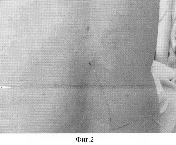Безопасный способ постановки эпидурального катетера в &quot;туннеле&quot; для продленной аналгезии (патент 2301083)