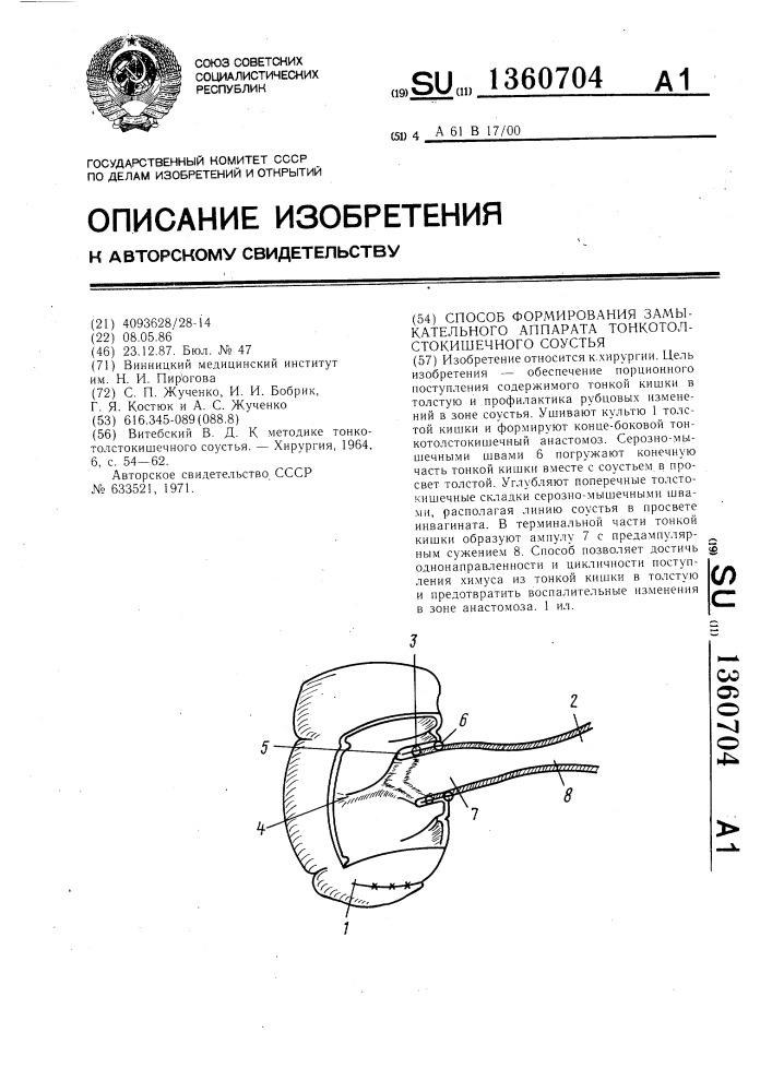 Способ формирования замыкательного аппарата тонкотолстокишечного соустья (патент 1360704)