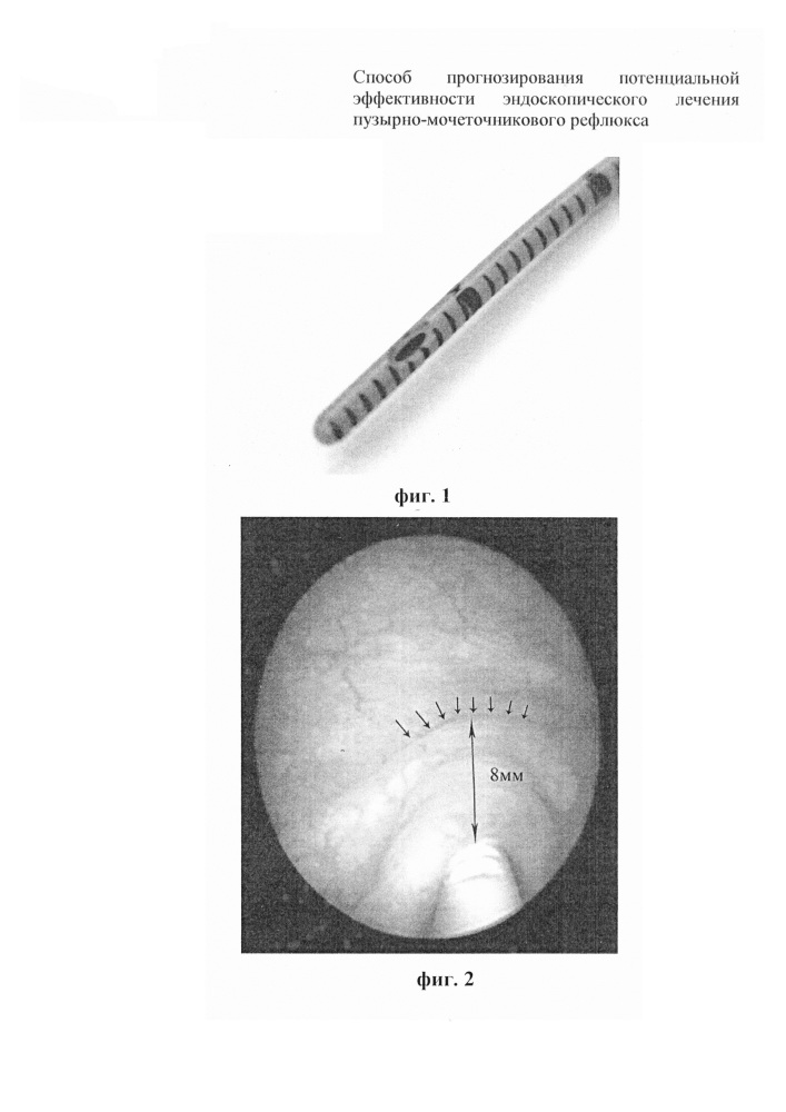 Способ прогнозирования потенциальной эффективности эндоскопического лечения пузырно-мочеточникового рефлюкса (патент 2645640)
