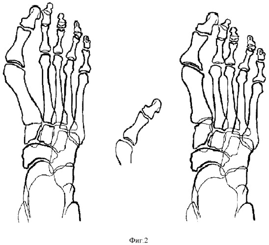 Способ оперативного лечения деформации переднего отдела стопы (патент 2428127)