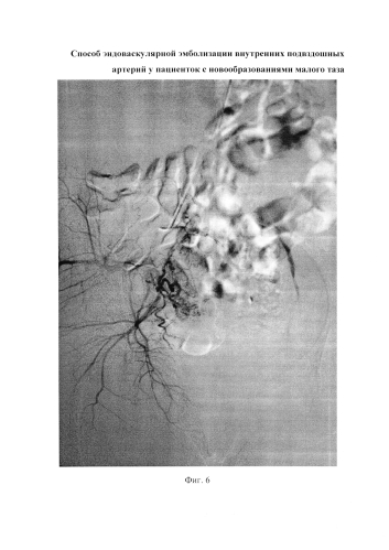Способ эндоваскулярной эмболизации внутренних подвздошных артерий у пациенток с новообразованиями малого таза (патент 2576092)