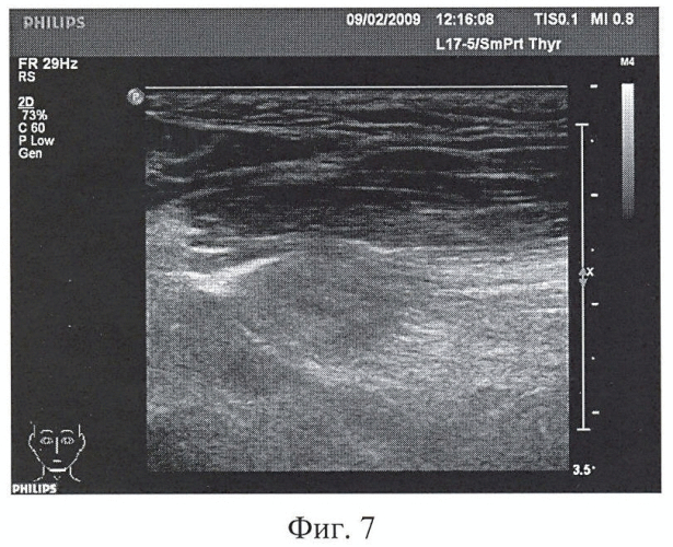 Способ исследования состояния языка и мягких тканей полости рта (внутриротовая сонография) (патент 2411006)