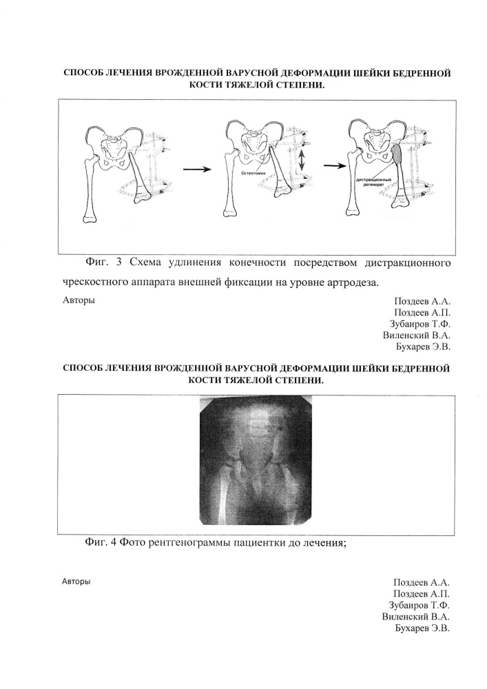 Способ лечения врожденной варусной деформации шейки бедренной кости тяжелой степени (патент 2635441)