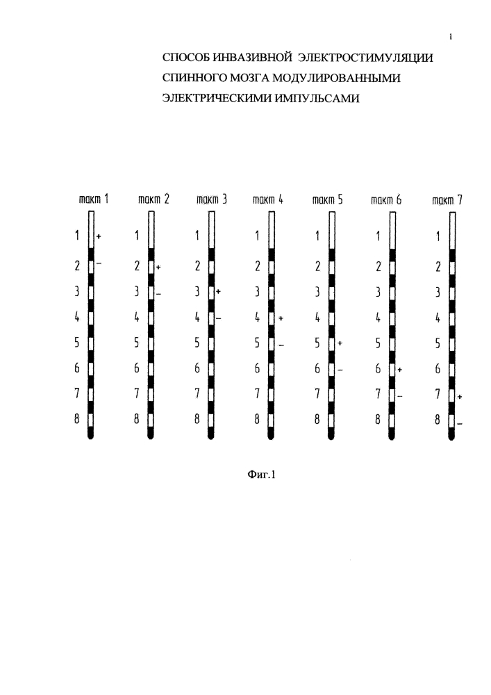 Способ инвазивной электростимуляции спинного мозга модулированными электрическими импульсами (патент 2618206)