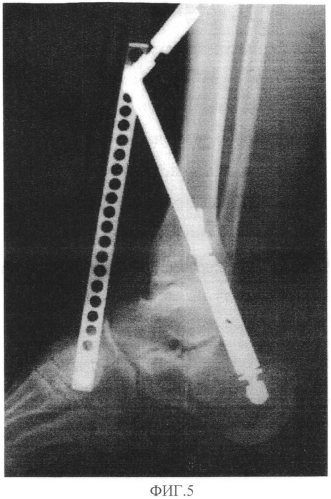 Способ восстановления целостности и функциональности пяточной кости человека и аппарат для его осуществления (патент 2566663)