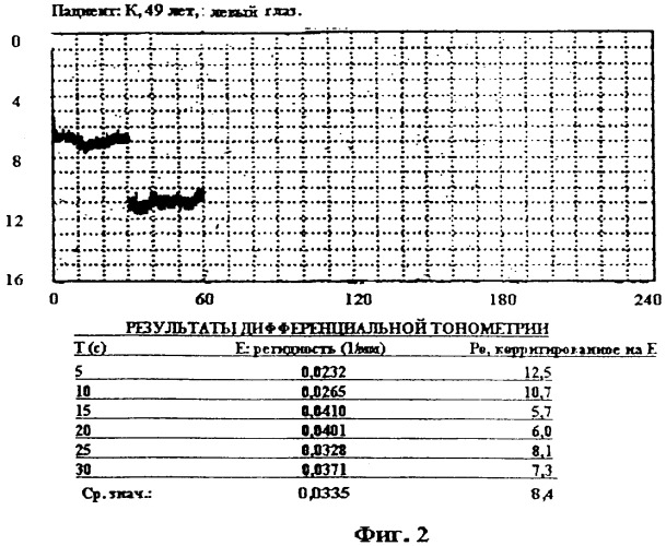 Способ дифференциальной тонометрии (патент 2314015)
