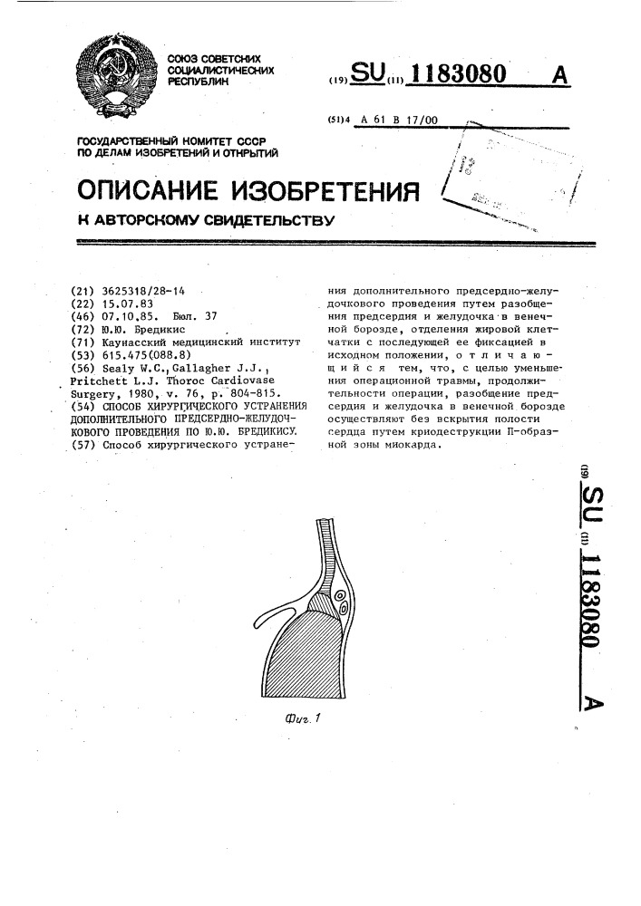 Способ хирургического устранения дополнительного предсердно- желудочкового проведения по ю.ю.бредикису (патент 1183080)