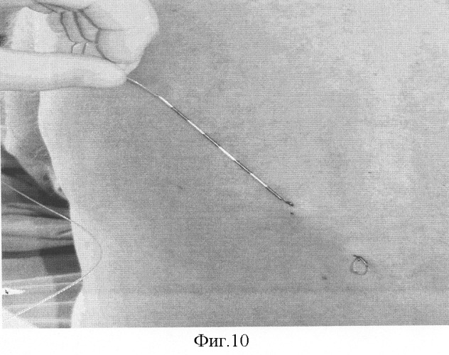 Безопасный способ постановки эпидурального катетера в &quot;туннеле&quot; для продленной аналгезии (патент 2301083)