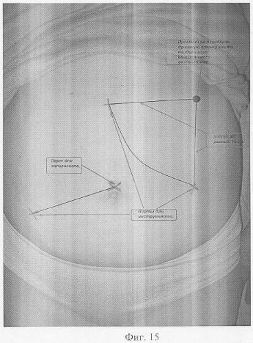 Способ определения мест оптимальной установки манипуляционных троакаров при лапароскопических операциях на органах забрюшинного пространства (патент 2338481)