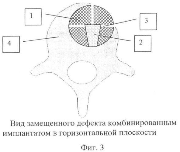 Способ переднего комбинированного спондилодеза при воспалительных заболеваниях позвоночника (патент 2364362)