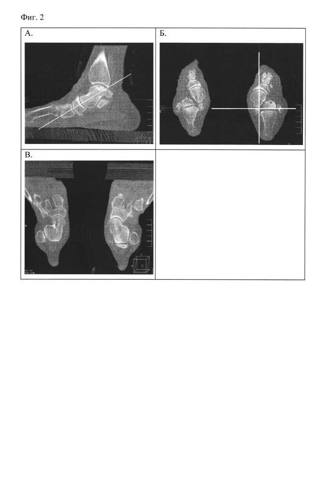 Способ мультиспиральной компьютерно-томографической диагностики заболеваний голеностопного сустава и стопы (патент 2659028)