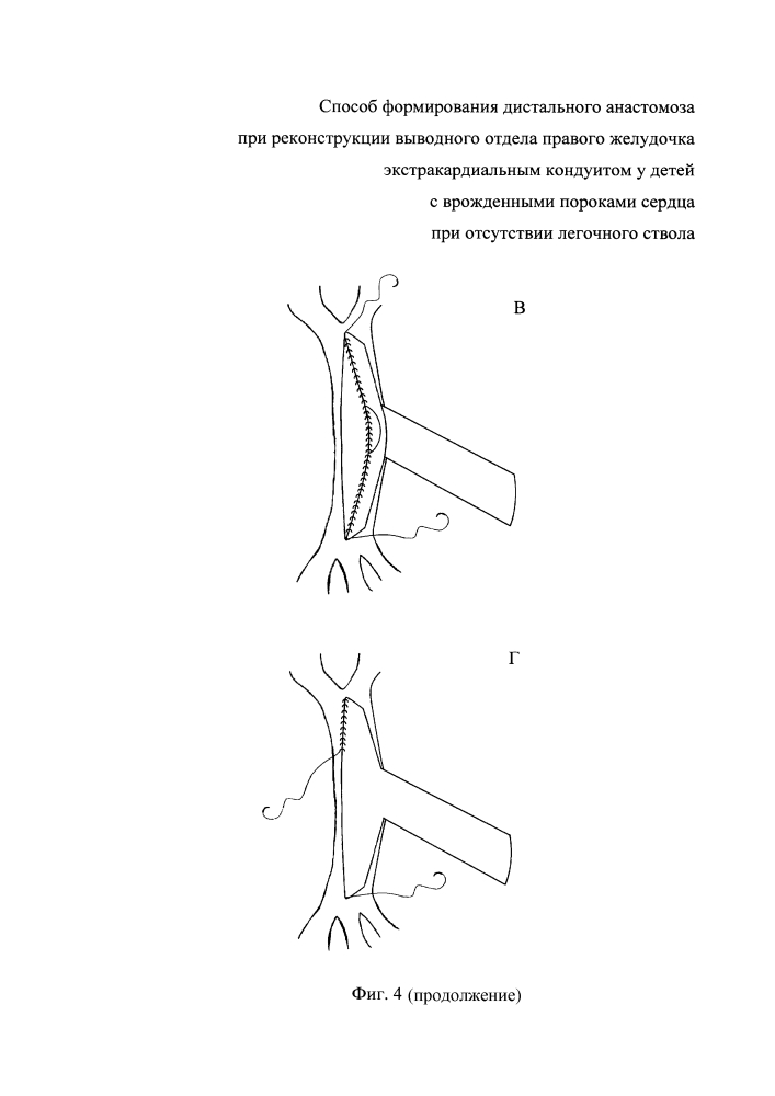 Способ формирования дистального анастомоза при реконструкции выводного отдела правого желудочка экстракардиальным кондуитом у детей с врожденными пороками сердца при отсутствии легочного ствола (патент 2644937)