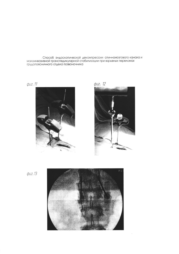 Способ эндоскопической декомпрессии спинномозгового канала и малоинвазивной транспедикулярной стабилизации при взрывных переломах грудопоясничного отдела позвоночника (патент 2649826)