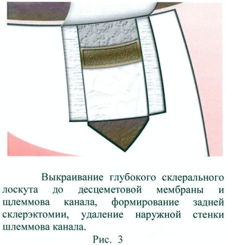 Способ хирургического лечения открытоугольной глаукомы (патент 2410066)