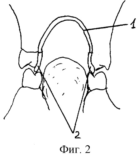 Аппарат для лечения синдрома гипермобильности височно-нижнечелюстного сустава (патент 2296533)
