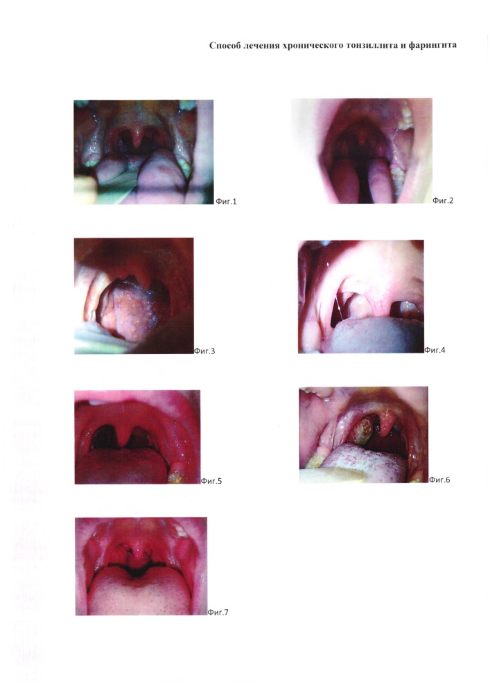 Способ лечения хронического тонзиллита и фарингита (патент 2652072)
