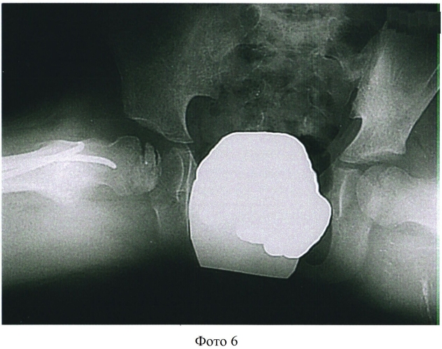 Способ хирургического лечения болезни пертеса у детей (патент 2552701)