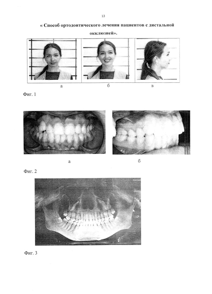 Способ ортодонтического лечения пациентов с дистальной окклюзией (патент 2648828)