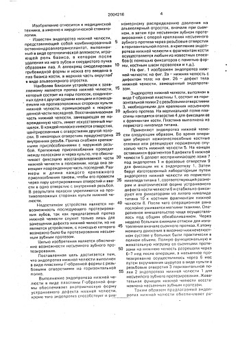 Эндопротез нижней челюсти (патент 2004216)
