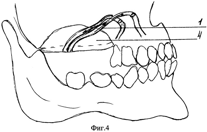 Способ устранения дефекта верхней челюсти (патент 2458643)