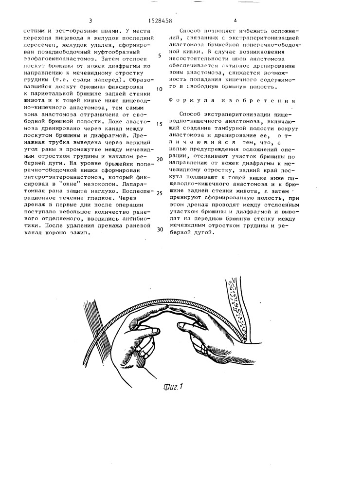 Способ экстраперитонизации пищеводно-кишечного анастомоза (патент 1528458)