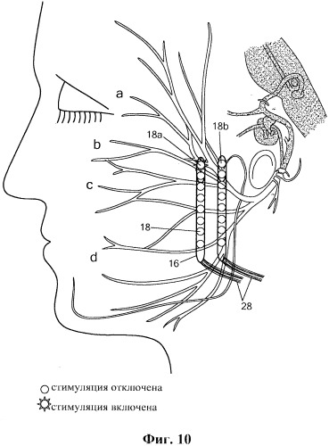 Система и способ стимуляции лицевого нерва (патент 2511082)