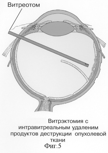 Способ электрохимической деструкции, хирургического удаления и фотодинамической профилактики рецидивов внутриглазных новообразований (варианты) (патент 2244531)