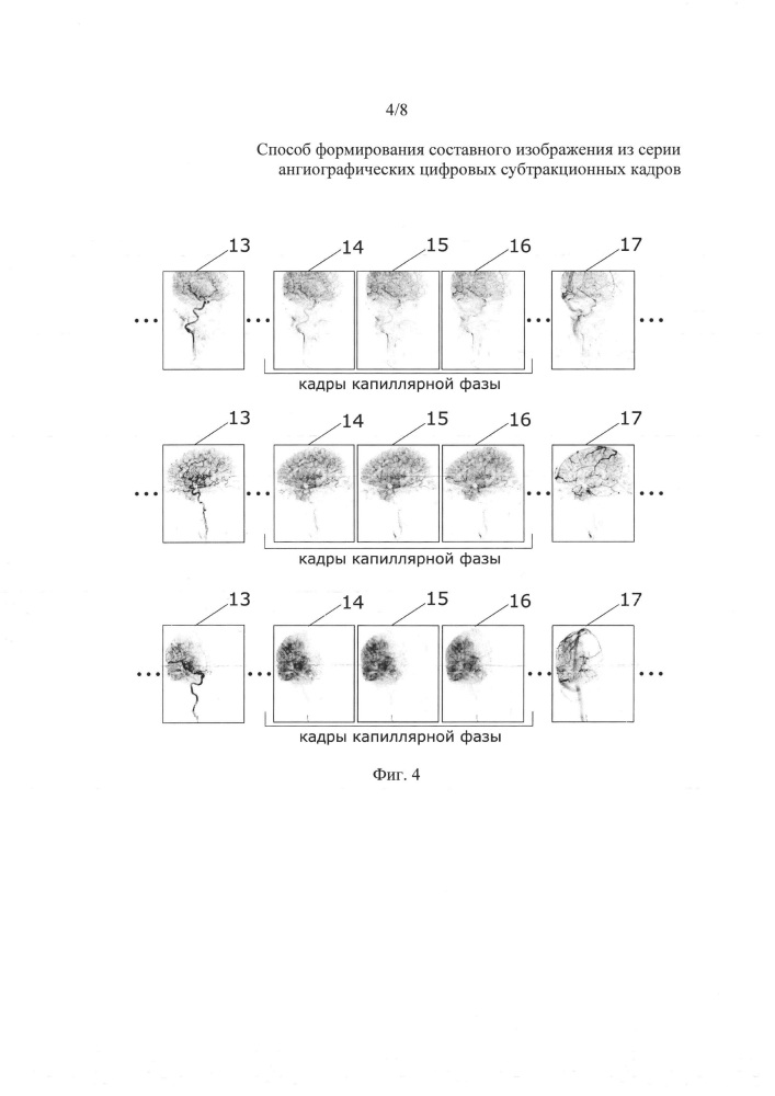 Способ формирования составного изображения из серии ангиографических цифровых субтракционных кадров (патент 2633949)