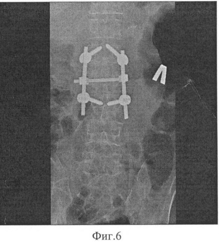 Способ транспедикулярного введения винтов (патент 2391061)