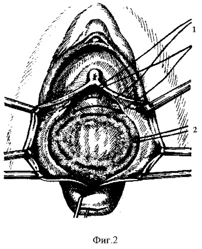 Способ хирургической реконструкции пузырно-влагалищной перегородки при опущении и выпадении передней стенки влагалища и цистоцеле (патент 2262314)
