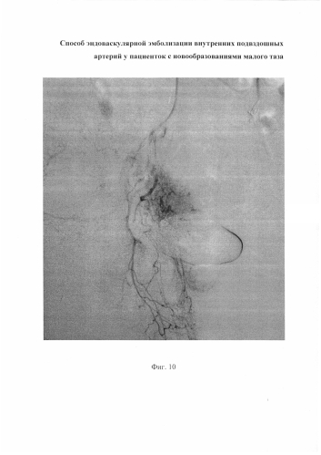 Способ эндоваскулярной эмболизации внутренних подвздошных артерий у пациенток с новообразованиями малого таза (патент 2576092)